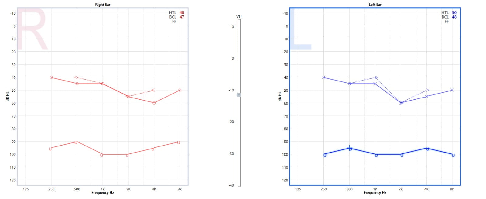 Audiogram results of an individual with hearing loss